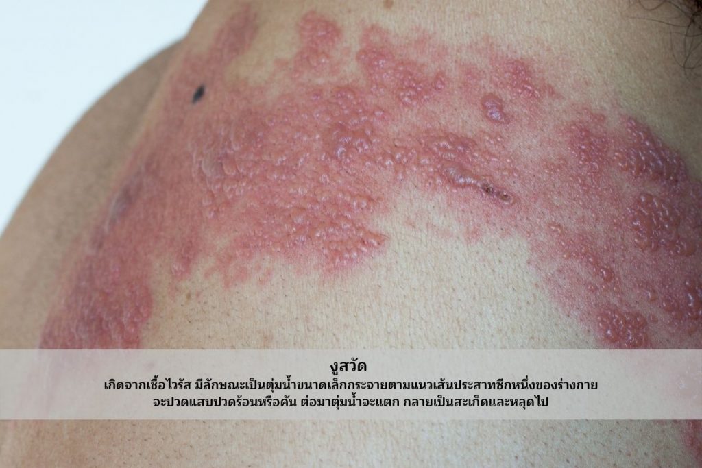 โรคติดเชื้อฉวยโอกาส คืออะไร และมีโรคอะไรบ้าง