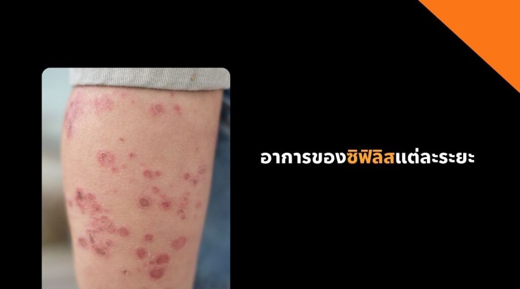 อาการของซิฟิลิสแต่ละระยะ