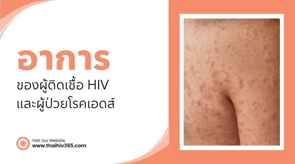 อาการของผู้ติดเชื้อ HIV และผู้ป่วย โรคเอดส์